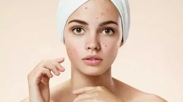 mỹ phẩm trị mụn hiệu quả