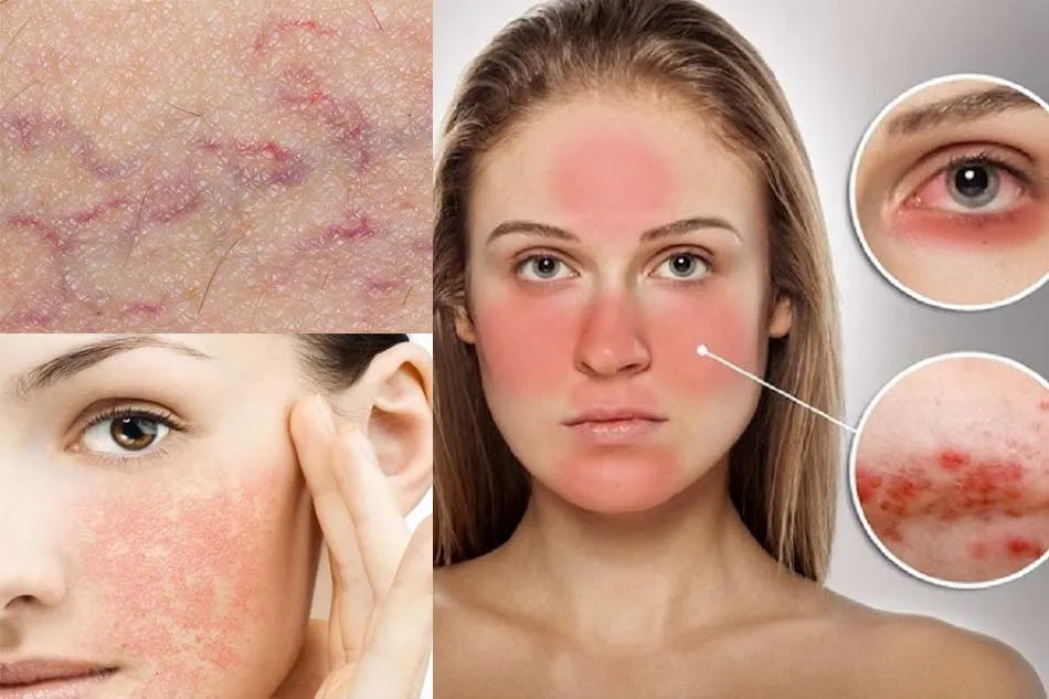 Những lưu ý quan trọng khi đồng hành cùng làn da nhạy cảm
