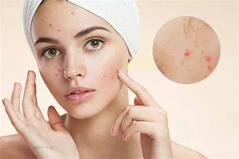 mỹ phẩm Hàn Quốc cho da mụn