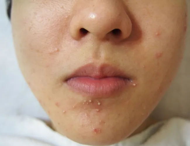 Mụn trứng cá - Vấn đề "nan giải" và các nguyên nhân cốt lõi