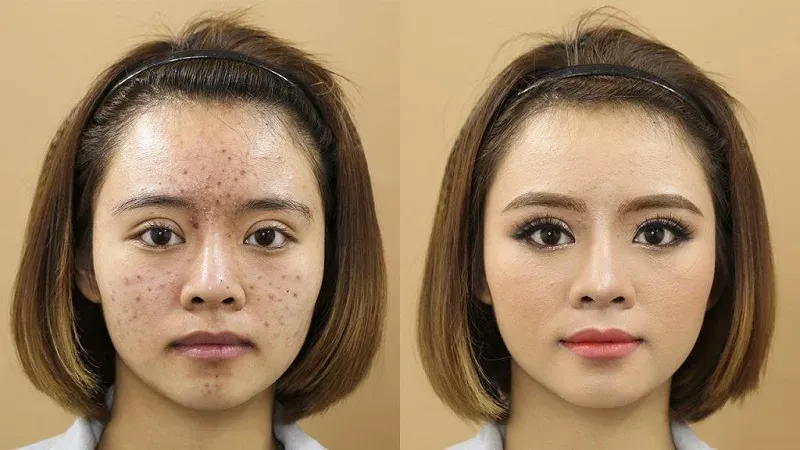 Những "thách thức" khi trang điểm cho da mụn