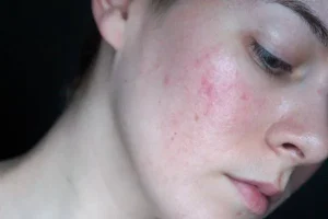 mỹ phẩm gây kích ứng da