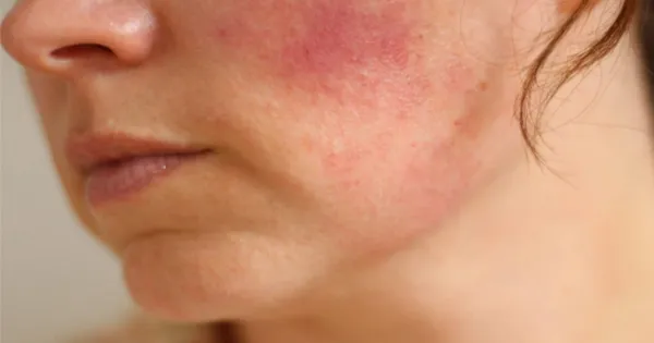 Cách phòng ngừa kích ứng da do mỹ phẩm - Bí quyết cho làn da khỏe mạnh